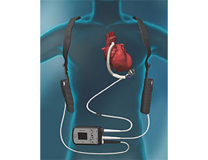 (LVAD) HeartMate 3